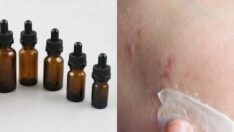 Salisilik asit nedir?