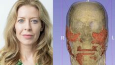 Tıp dünyası şokta: Botoksun verdiği hasar ortaya çıktı, 20 yıllık kimyasal yüzünden çıktı