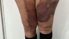 Yağ aldırmak için Türkiye’ye geldi, ameliyat sonrası hayatı kabusa döndü 