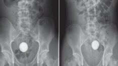 Doktorlar şaştı kaldı… Gencin anüsünden giren nesneyi zor çıkardılar