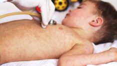 Yıllardır görülmüyordu: Kızamık vakaları yeniden ortaya çıktı