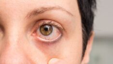 Adenovirüs enfeksiyonu nedir? Adenovirüs belirtileri neler?