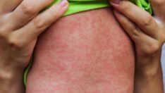 Bilim Kurulu üyesinden İstanbul için kızamık uyarısı: Vaka sayısında artış var