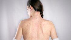 Zona nedir, belirtileri ve tedavi yöntemleri