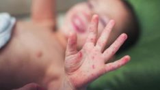 Avrupa’da kızamık ve boğmaca alarmı