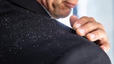 Kepek neden olur, nasıl geçer?