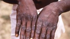 Kongo’da yeni salgın alarmı