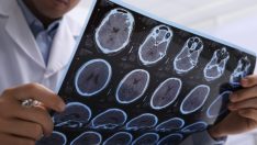 Alzheimer hastalığının genetiğiyle ilgili dikkat çekici araştırma