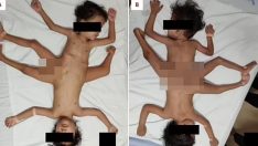 Çok nadir görülüyor: Pelvis bölgesinden yapışık ikizler tıp tarihine geçti