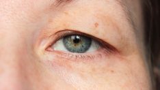 Göz kapağı düşüklüğü neden olur, nasıl geçer?