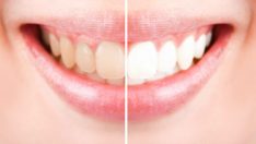 Sarı ve lekeli dişleri engelleyebilecek iki öneri