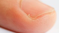 Şeytan tırnağını koparanlar dikkat! Az kalsın parmağı kesilecekti