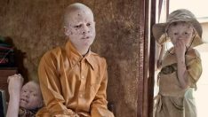 Tanzanya albinoları zorlu yaşam koşullarıyla baş etmeye çalışıyor