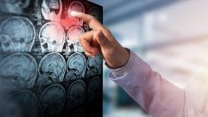 Türkiye’de her 15 dakikada 1 kişi inme nedeniyle ölüyor