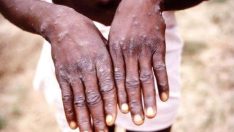 Afrika’da M çiçeğinden ölenlerin sayısı 1100’e çıktı