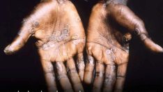 Zimbabve ve Zambiya’da ilk M çiçeği vakaları tespit edildi