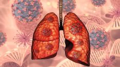 Ölüm oranı en yüksek kanserlerin başında geliyor! Türkiye’de binlerce yeni vaka tespit edildi!