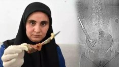 Baş ağrısı şikayetiyle hastaneye gitti: Karnında 7 yıl önce makas unutulduğunu öğrendi!