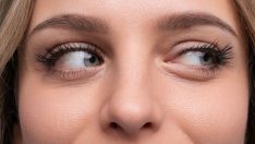 SULANMA VE KAŞINTI VARSA DEMODEX PARAZİTİNE DİKKAT