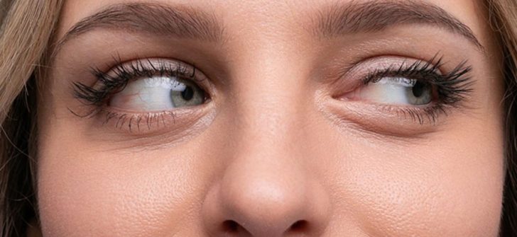 SULANMA VE KAŞINTI VARSA DEMODEX PARAZİTİNE DİKKAT