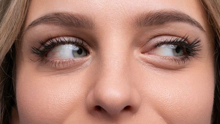 SULANMA VE KAŞINTI VARSA DEMODEX PARAZİTİNE DİKKAT